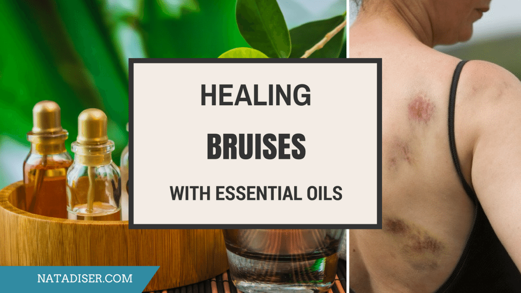 How to Heal a Bruise Quickly Using Essential Oils