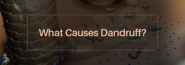 what-causes-dandruff