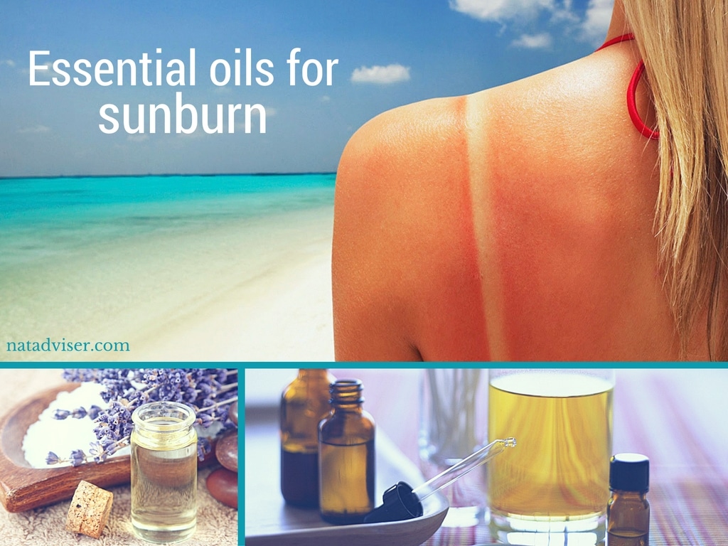Essential oils for sunburn