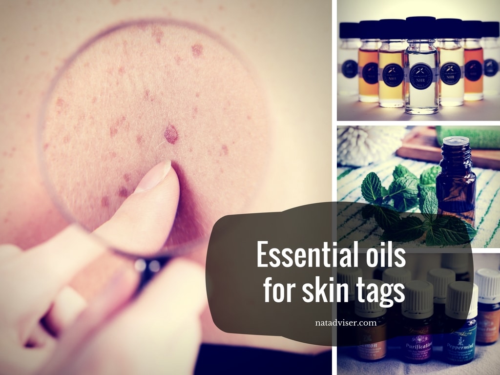 Best Essential Oils For Skin Tags Removal 3 Top Recipes